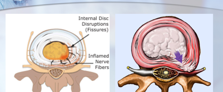 The Painful Disk