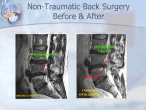 Dr. Luis Lombardi-L4/L5 Extruded Herniated Disc