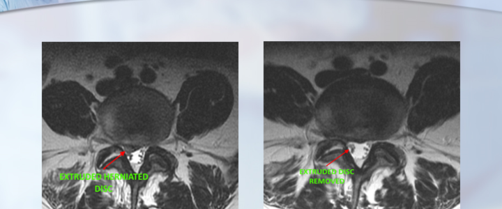 Non-Traumatic Back Surgery Before & After