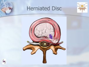 Dr. Luis Lombardi-Herniated Disc