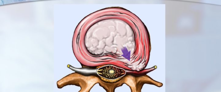 Dr. Luis Lombardi-Herniated Disc