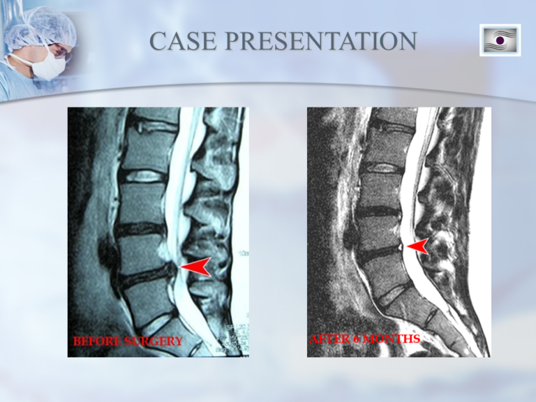 Dr. Luis Lombardi-L4/L5 Herniated Disc - Doctor Luis Lombardi