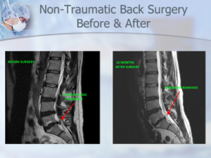 Dr. Luis Lombardi-16 Months After Surgery