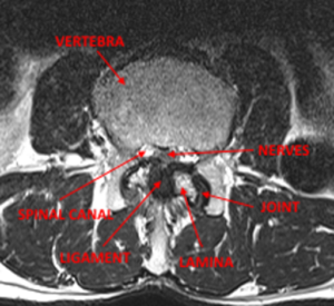 Dr. Luis Lombardi-Spinal Stenosis