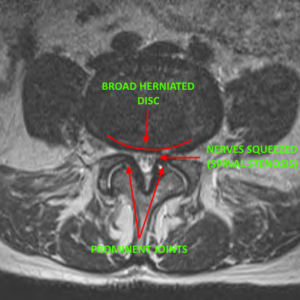 Dr. Luis Lombardi-Spinal Stenosis