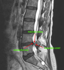 Dr. Luis Lombardi-Spinal Stenosis