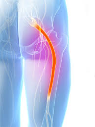 Causes and Symptoms of Sciatica by Dr Luis Lombardi
