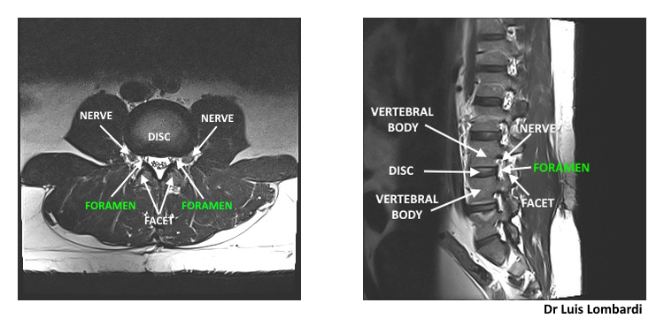 Lumbar MRI showing a normal foramen with preserved space around the exiting nerve root