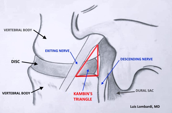 Diagram of Kambin’s triangle, the ‘safe zone’ used in lumbar endoscopic spine surgery to reach the disc while avoiding nearby nerves