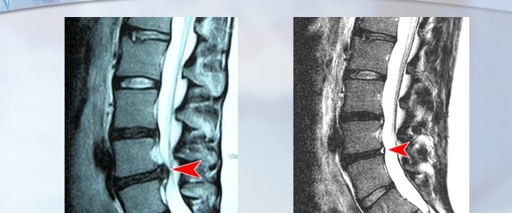 Dr. Luis Lombardi-L4/L5 Herniated Disc