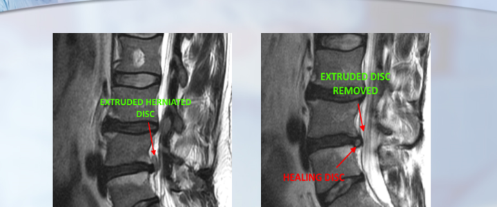 Dr. Luis Lombardi-L4/L5 Extruded Herniated Disc