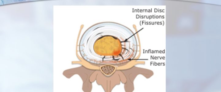 Dr. Luis Lombardi-Painful Disc