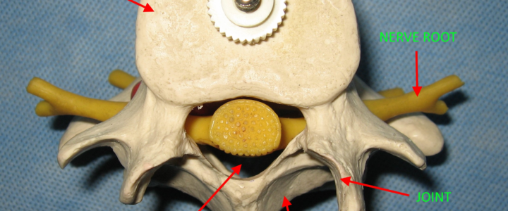 Dr. Luis Lombardi-Spinal Canal