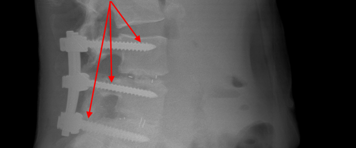 Dr. Luis Lombardi-Spinal Fusion