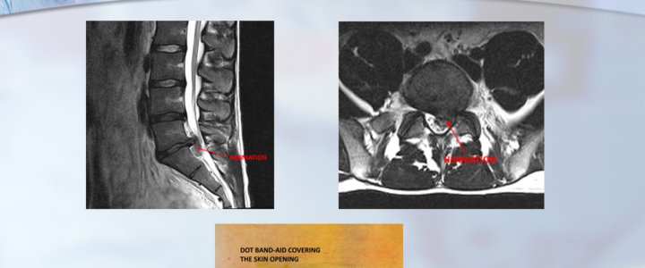 Dr. Luis Lombardi-Olympic Athlete with Large Herniated Disc