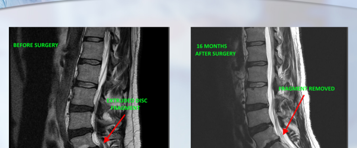 Dr. Luis Lombardi-16 Months After Surgery