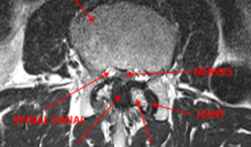 Dr. Luis Lombardi-Spinal Stenosis