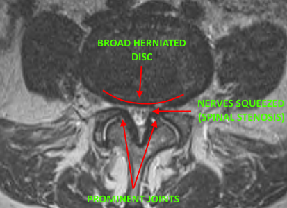 Dr. Luis Lombardi-Treating Spinal Stenosis