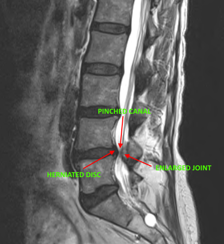 Dr. Luis Lombardi-Treating Spinal Stenosis - Doctor Luis Lombardi