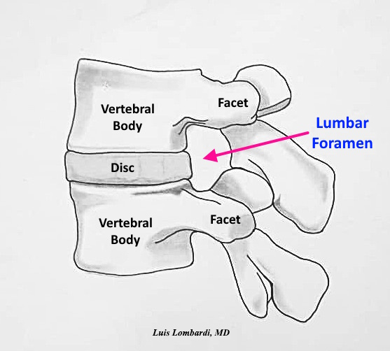 Lumbar foramen location between vertebral body, disc, and facet joint in endoscopic spine surgery